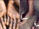 Monkeypox : युरोपसह 12 देशांत 'मंकीपॉक्स'चा फैलाव; केंद्र सरकार ॲक्शन मोडमध्ये, दिले 'हे' निर्देश l Monkeypox Outbreak In Europe, US Raises Concerns In India